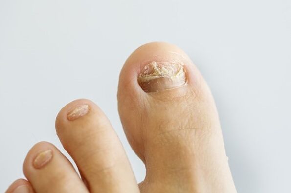 Nail mushroom