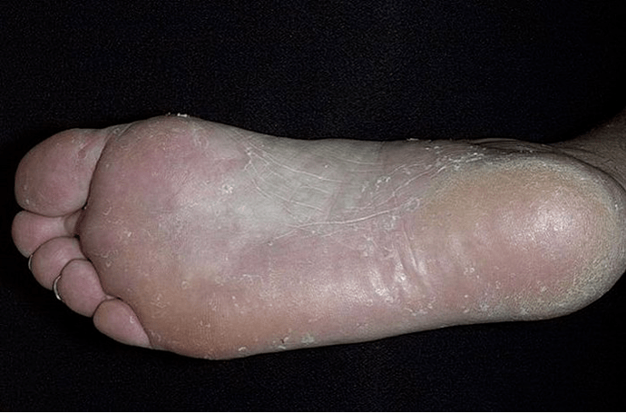 The foot fungus