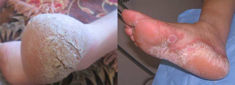 The feet affected by the fungus
