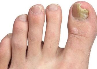 Nail fungi symptoms