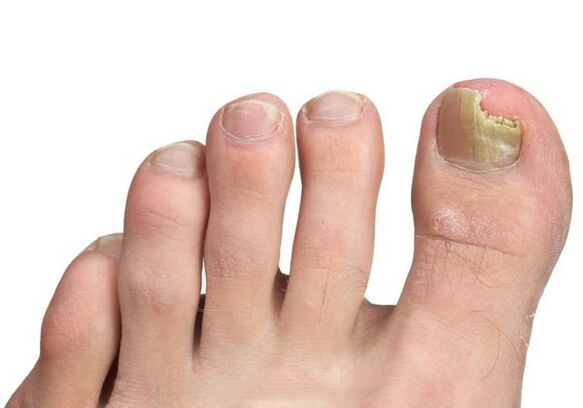 How is a fungus infection