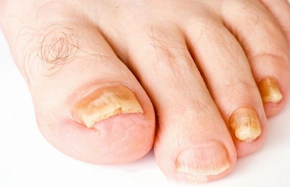 Nail mushroom