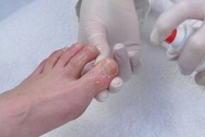 nail fungus treatment