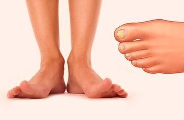 Nail mushroom