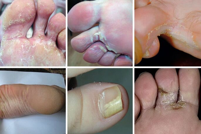 Dyshidrotic form of foot fungus