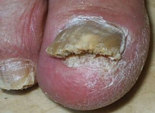 nail fungus pictures