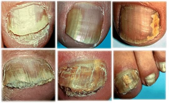 types and forms of fungus on the nails