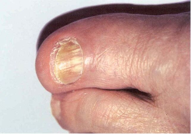 Onychomycosis - infection of the nails by fungi