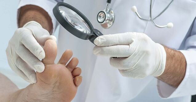 The doctor will prescribe a remedy for nail fungus after diagnosing the disease