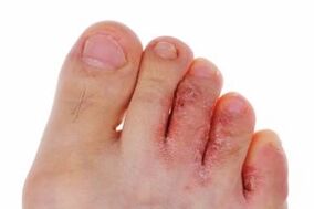 fungal infection of toes