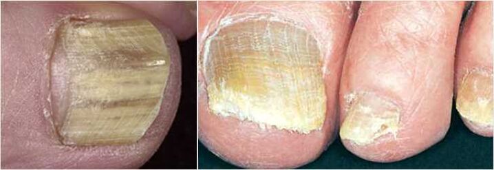 fungus on nails