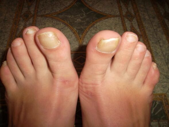 Fungal nail infection of the big toe