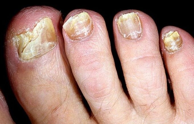 Advanced nail fungus requiring complex treatment