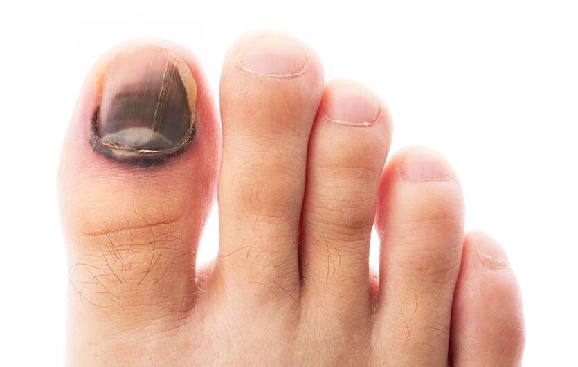 Fungal infection of the toenail plate